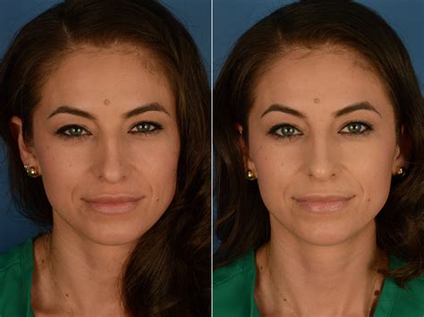 Injectable Filler Rhinoplasty Photos | Naples, FL | Patient 15590