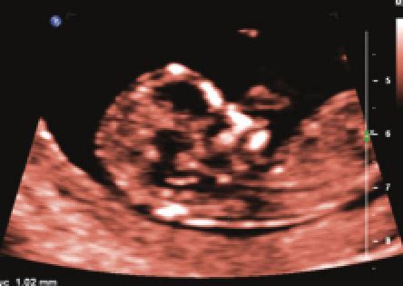 4: Another normal nuchal translucency measurement | Download Scientific Diagram