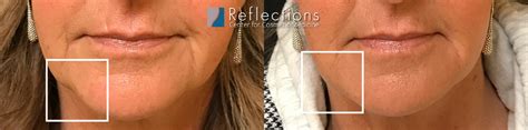 Marionette Line Filler Before & After Photos New Jersey - Reflections ...