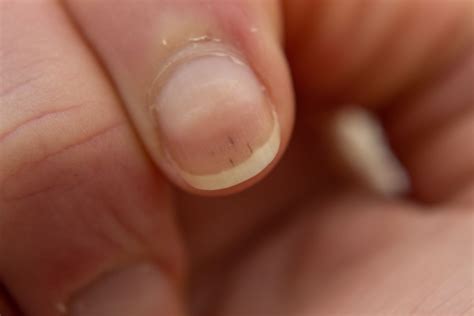 Nail Changes in Kidney Disease: Symptoms, Causes, and Remedies - World ...