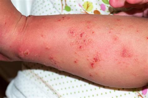 Scabies Rash On Thighs