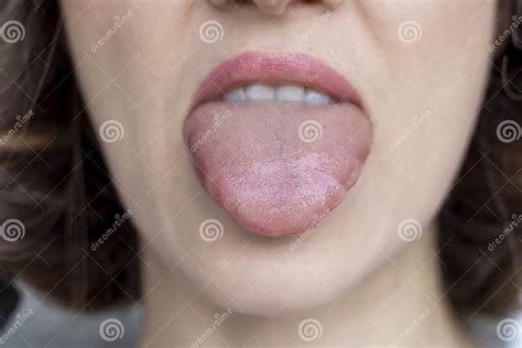 Close-up Swelling of the Tongue. Allergic Reactions, Infections, Angioedema, Trauma or Injury ...