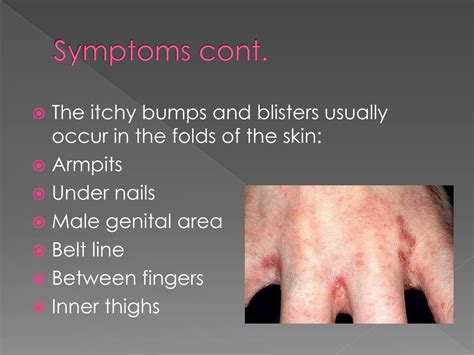PPT - Scabies PowerPoint Presentation, free download - ID:392899