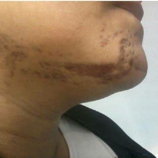 Skin biopsy show intact epidermis with an underlying dermal epithelial... | Download Scientific ...