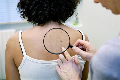 Skin Cancer | Basal Cell Carcinoma | MedlinePlus