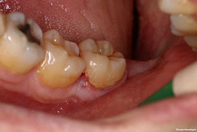 Extraction of a mandibular third molar with sectioning