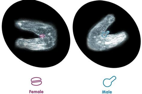 How to predict baby s gender from an early ultrasound – Artofit