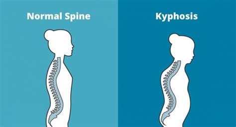 Kyphosis | Altair Health