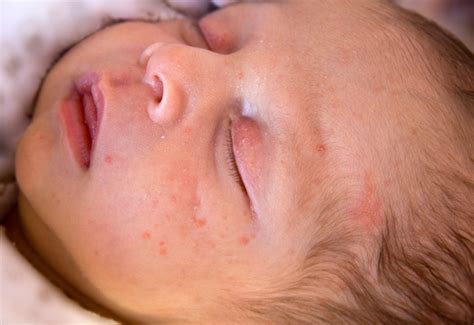 Newborn Skin 101 | Johns Hopkins Medicine