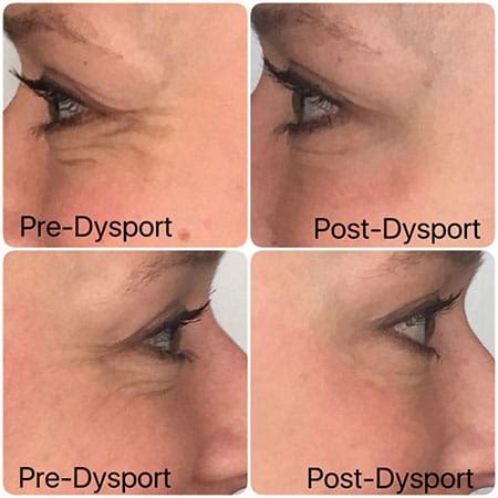 Denver Dysport Injections – Adore Aesthetix