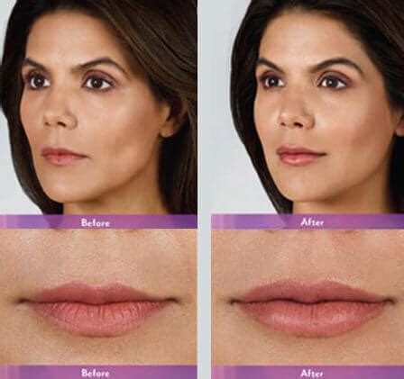 Juvederm Lips Before And After Pics | Lipstutorial.org