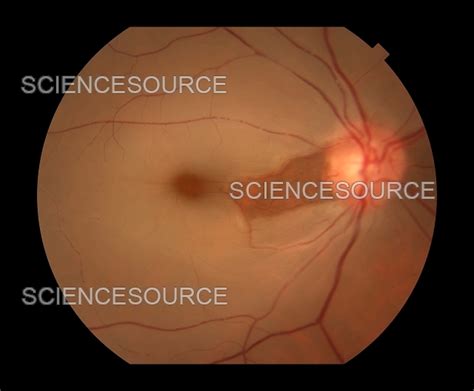 Photograph | CRAO With Cilioretinal Artery | Science Source Images