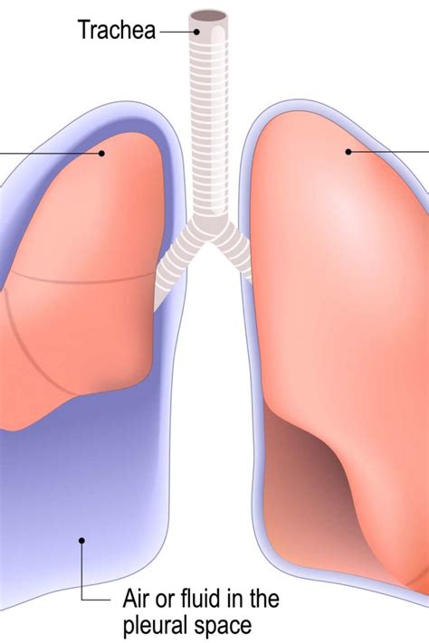 Punctured lung (pneumothorax): Symptoms, treatment, and recovery