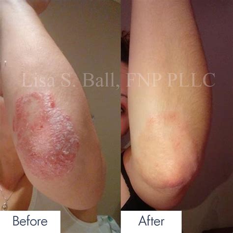 Kim Kardashian Psoriasis Archives - Lisa S. Ball, NP