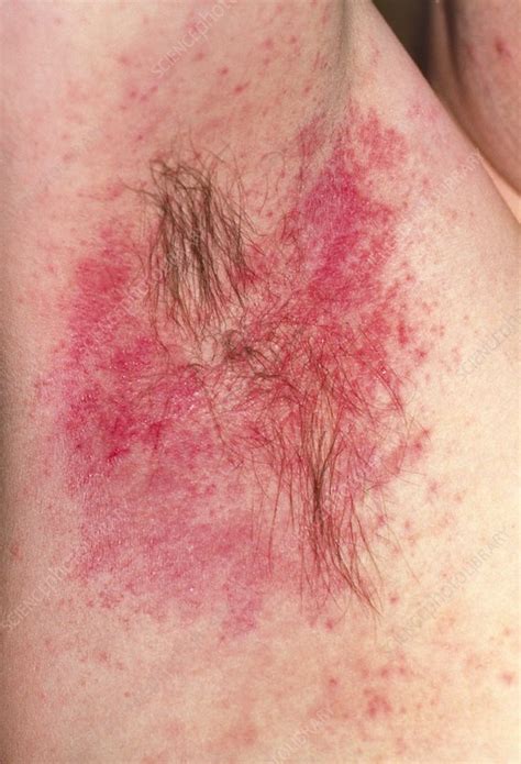 Circular Rash Under Armpit