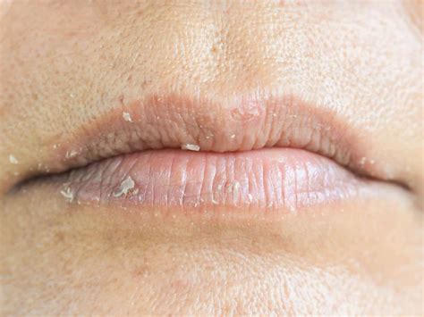 Itchy Lips Symptoms Causes Treatment And Prevention - vrogue.co