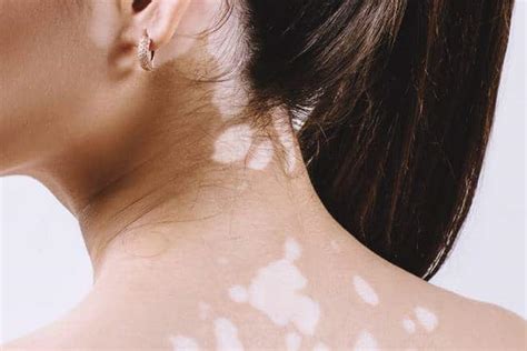 World Vitiligo Day 2019: Be informed! Vitiligo or leucoderma is not contagious - Life News | The ...