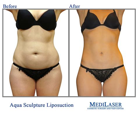 360-Liposuction-Before-And-After - Medilaser Surgery and Vein Center