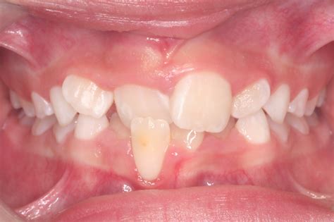 anterior crossbite - Iowa City Orthodontics