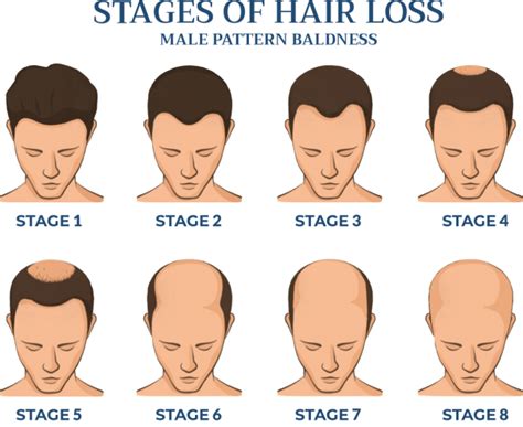 Hair Loss in Men | Male Hair Loss | Cranial Prosthesis Center