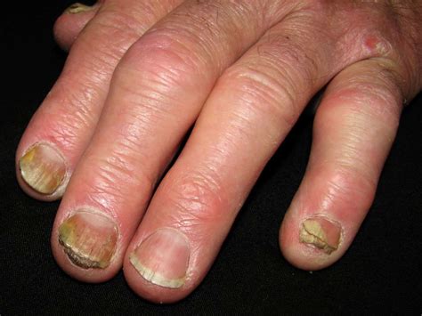 Psoriatic Arthritis Nails: Signs, Treatment, and Photos