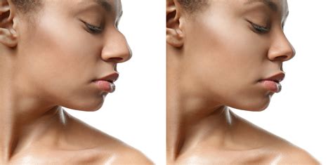 How Long Is Recovery From Rhinoplasty? | Facial Plastic Surgery Omaha