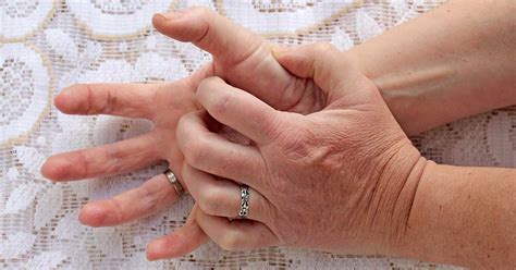 Common Symptoms of Gout in Hands and What to Do About It