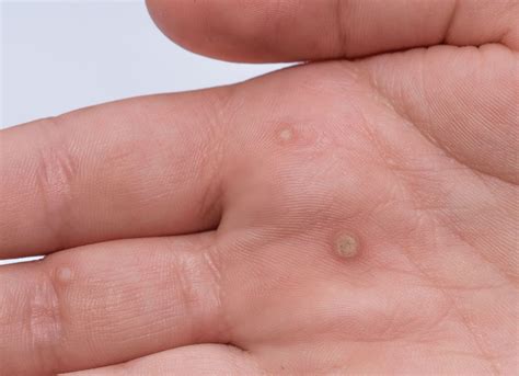 Warts | Fungal Skin Infections | Viral Skin Infections