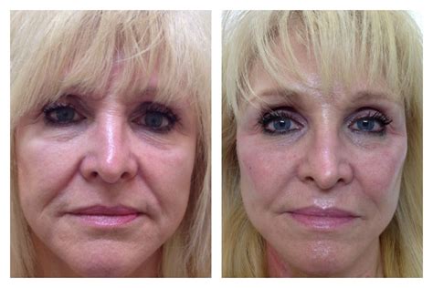 Liquid Facelift | Liquid facelift, Neck lift, Facelift before and after