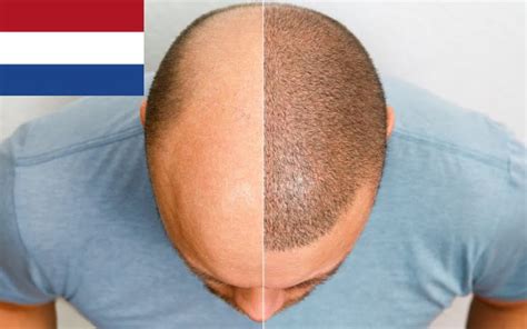 Best Hair Transplant Clinics in the Netherlands | Top 5 Countries, Prices & More - MedClinics