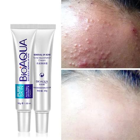 BIOAQUA Acne Cream anti Acne moisturizing anti wrinkle Face Acne Treatment Scars Removal Gel ...