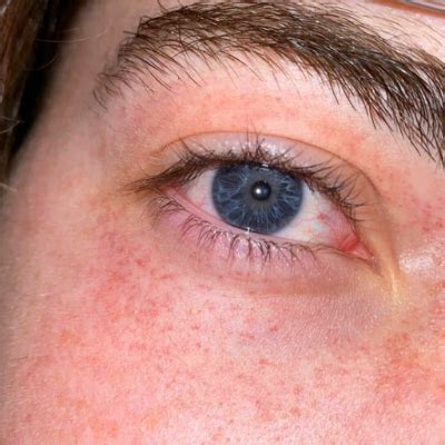 Red Dots Around Eyes: Causes, Treatment, and When to Worry