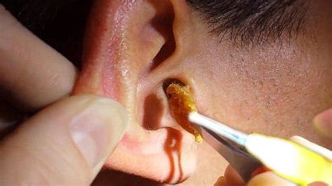 Lighted Earwax Pick! Ear Wax Removal Tools - YouTube