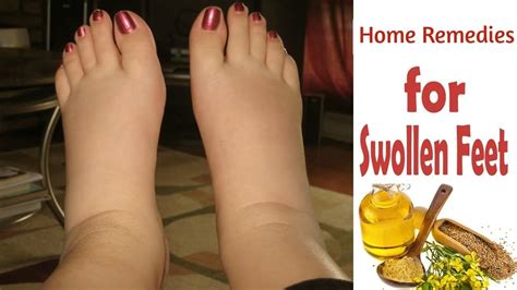 6 Natural Soothing Home Remedies For Swollen Feet And Ankles - YouTube