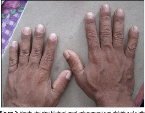 Figure 2 from Touraine Solente Gole syndrome: The elephant skin disease | Semantic Scholar