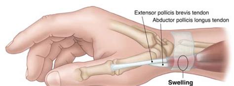 Don’t push through wrist pain - Capital Clinic Physiotherapy