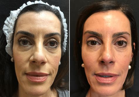 NonSurgical Facelift with Botox, Voluma, and Sculptra Before & After Photos New Jersey ...