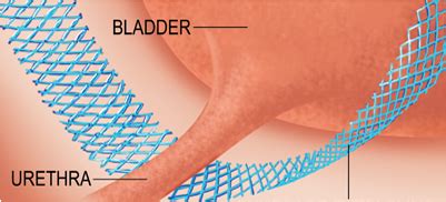 The Bladder Sling: Everything you need to know