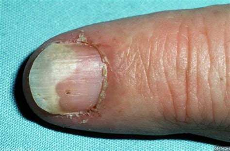 nail psoriasis pictures - pictures, photos