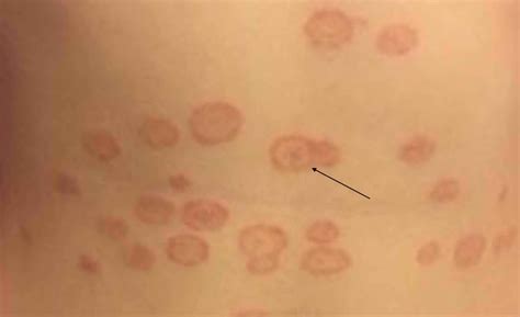 Tinea versicolor: common skin disease - Apps Treatment