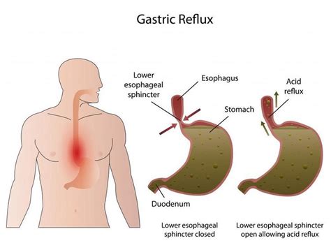 Bile Reflux Home Remedy and other effective Natural cures