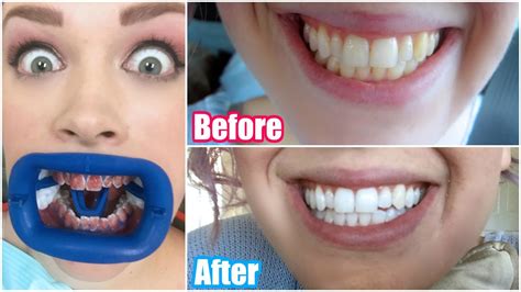 My Professional Teeth Whitening Experience! BEFORE & AFTER - YouTube