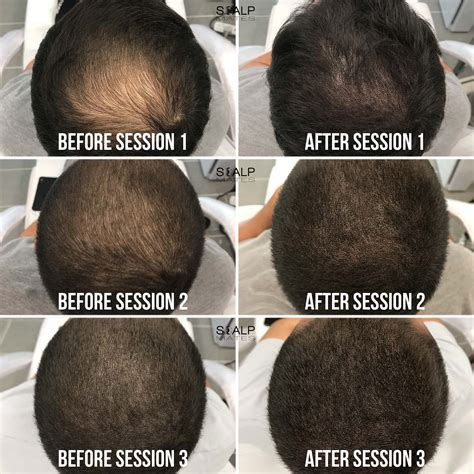 Scalp Micropigmentation SMP for Long Hair in Birmingham UK | Results & Process