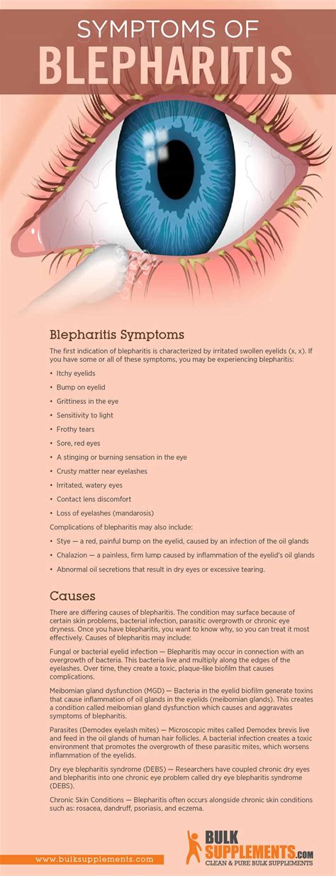 Tablo | Read 'Blepharitis Symptoms, Causes & Treatment' by