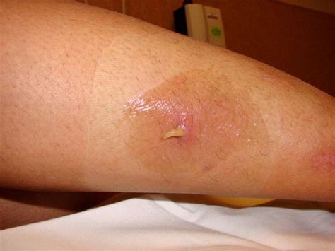 Furuncular Myiasis From Dermatobia Hominus: A Case of Human Botfly ...