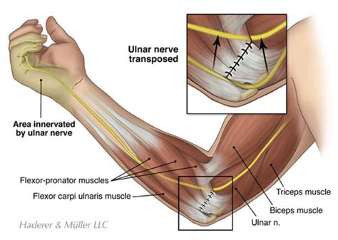 Patient Education Article - Columbia Orthopaedic Group - Patient Education