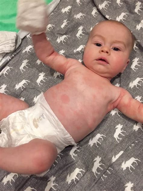 Symptoms of Allergic Reactions in Babies - Solid Starts