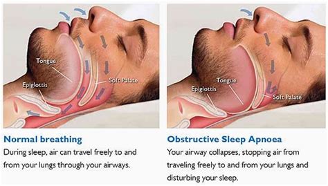 Sleep Apnea Obesity