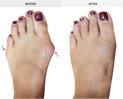 Bunion Surgery Before & After Gallery | Bunion Institute LA