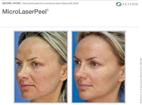 MicroLaser Peel - Prairie Du Sac, WI